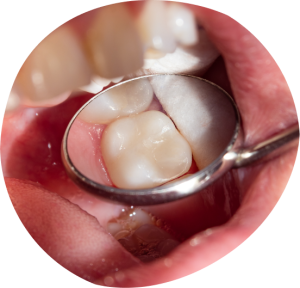 Close-up of a dental mirror reflecting a filled tooth in a child's mouth, illustrating the dental filling process for cavity treatment in pediatric dentistry.