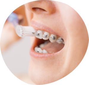 Orthodontics at Dental Care Group Kids