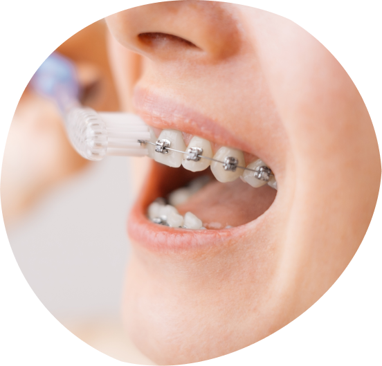 Orthodontics at Dental Care Group Kids