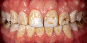severe dental fluorosis
