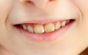 cavity white spots and enamel erosion on child's teeth