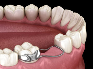 Illustration of a dental space maintainer in a child's mouth, demonstrating its role in preserving space after tooth extraction for proper eruption of permanent teeth.