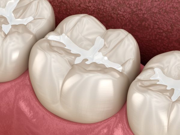 Molar,Fissure,Dental,Fillings,,Medically,Accurate,3d,Illustration,Of,Dental dental sealants
